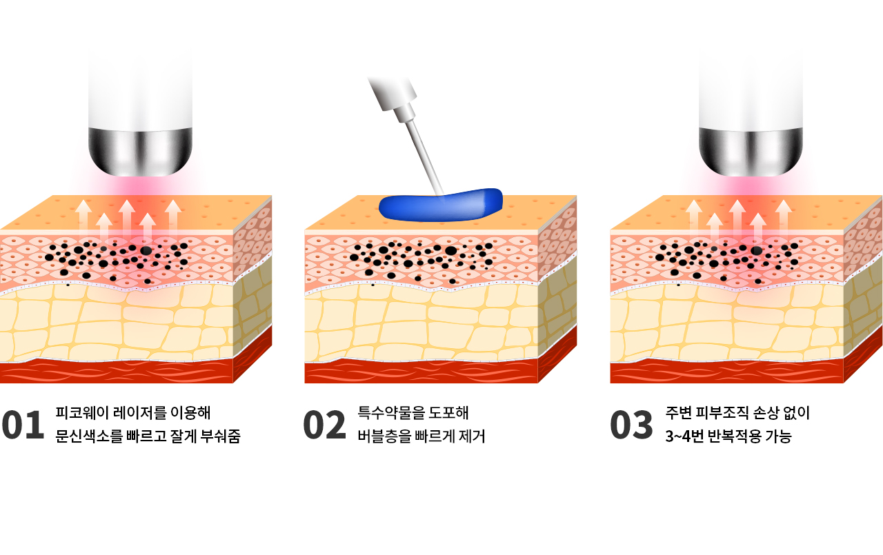 R제로 테크닉